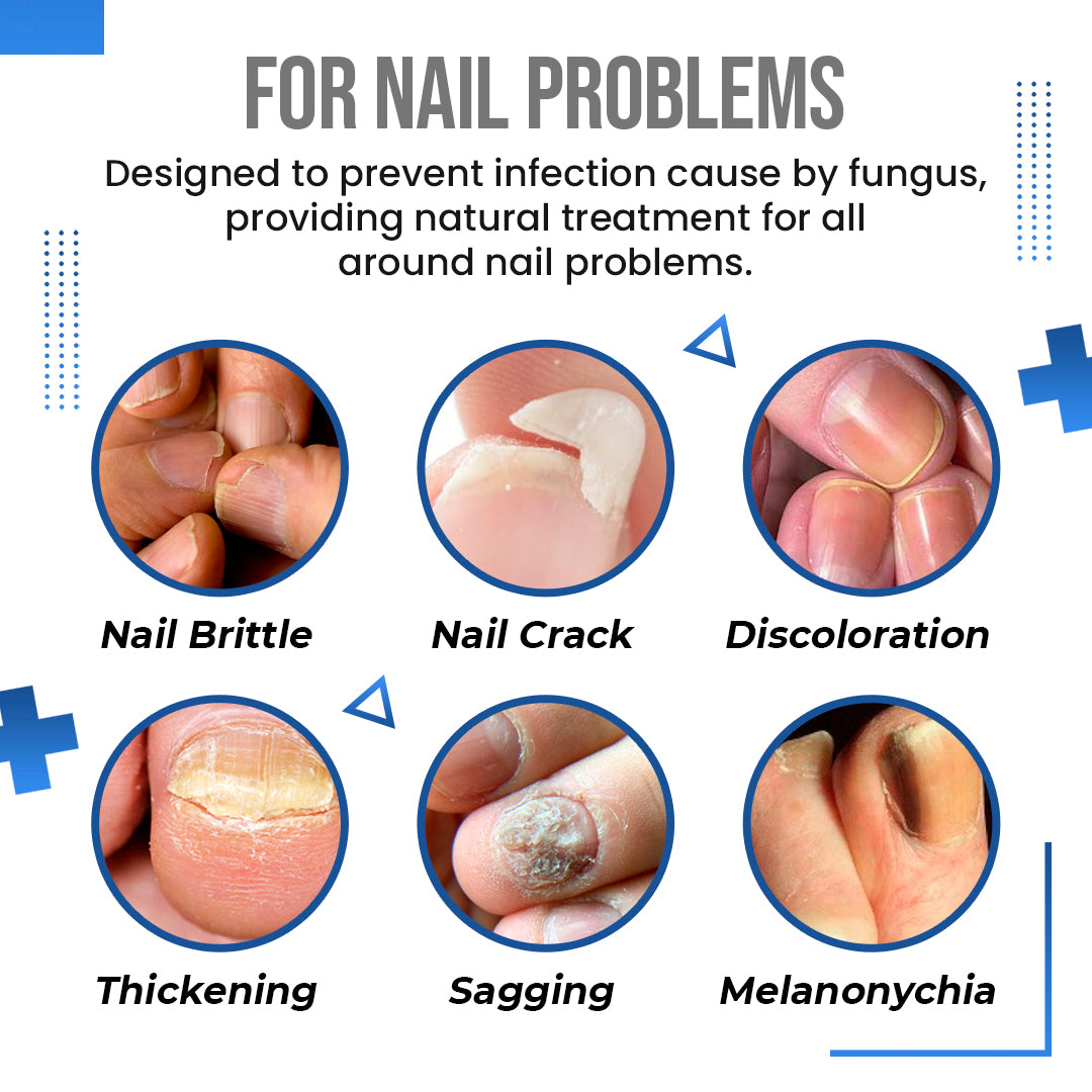 Anti Fungus Blue Light Laser Pen