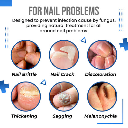 Anti Fungus Blue Light Laser Pen