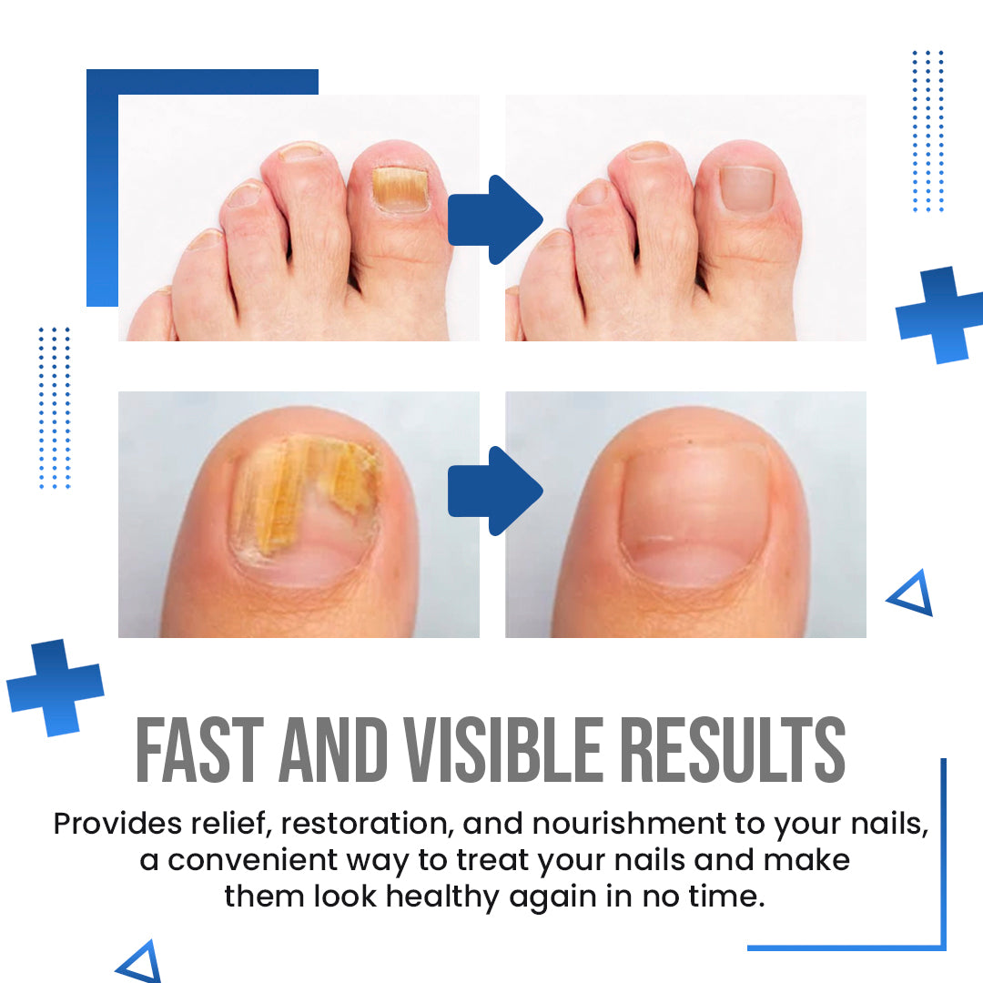 Anti Fungus Blue Light Laser Pen