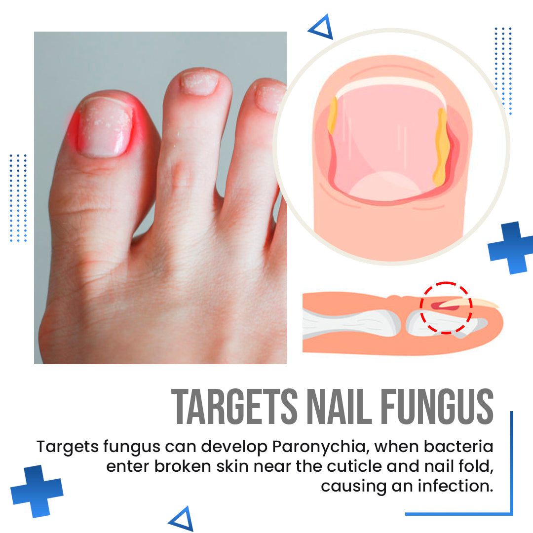 Anti Fungus Blue Light Laser Pen