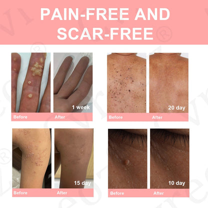 Dual Acid Wart & Mole Removal Serum