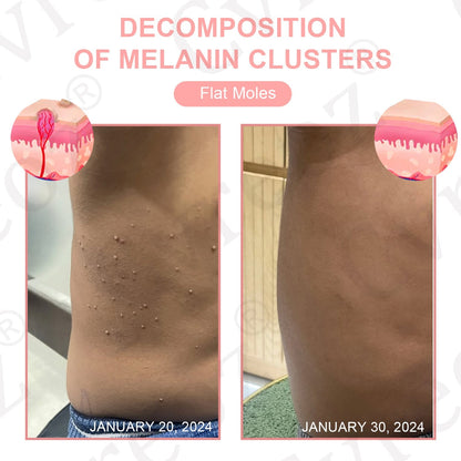 Dual Acid Wart & Mole Removal Serum