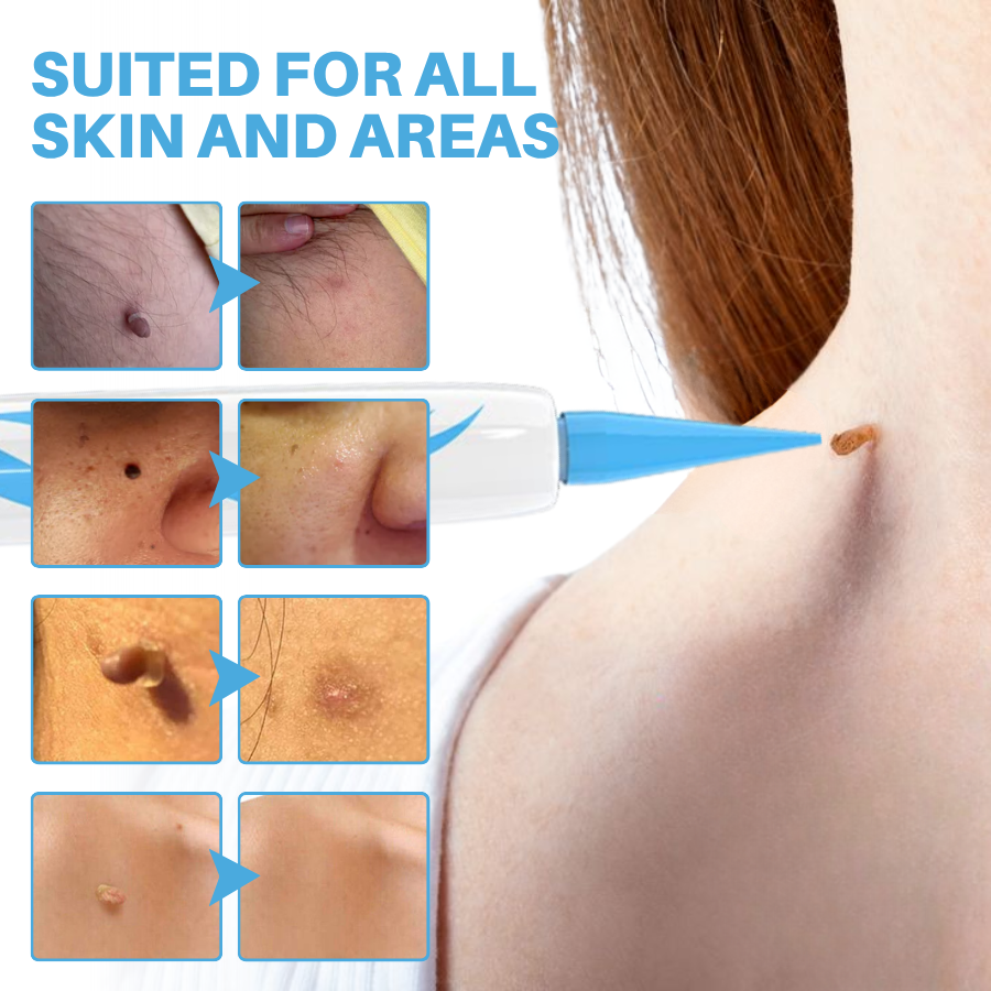 Painless At-home Skin Tag Removal Pen