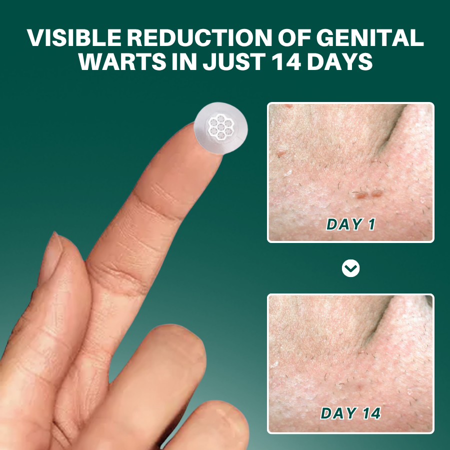Magnesium MicroPin HPV Genital Wart Removal Patch