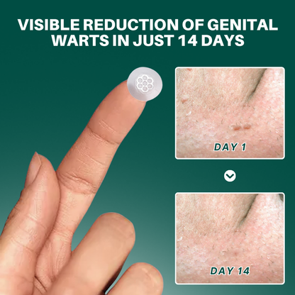 Magnesium MicroPin HPV Genital Wart Removal Patch