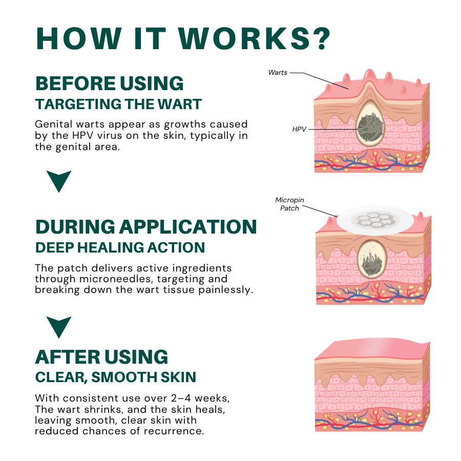 Magnesium MicroPin HPV Genital Wart Removal Patch