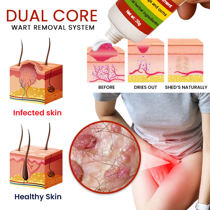 FemGenital Wart Remover Cream