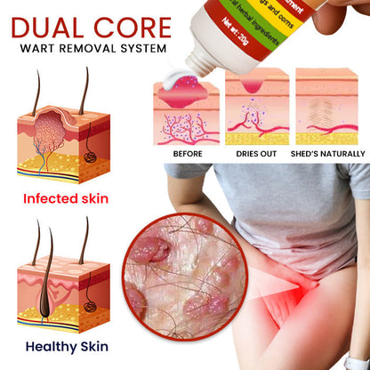 FemGenital Wart Remover Cream