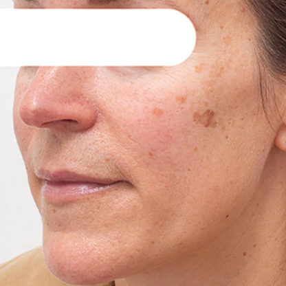 Herbal Spots Peel-Off Facial Mask PRO