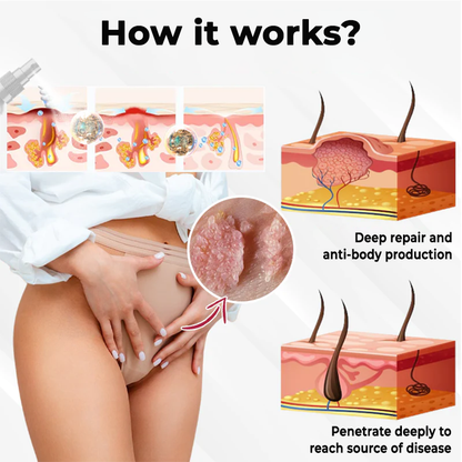 Female HPV Genital Wart Caring Spray
