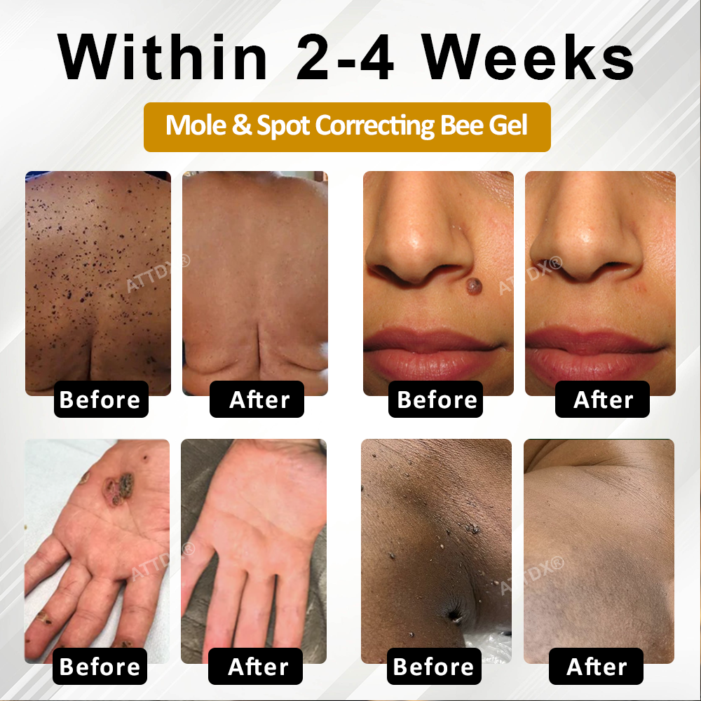 Advanced Mole & Spot Correcting Bee Gel