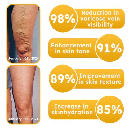 Bees Venom Varicose Veins Cream
