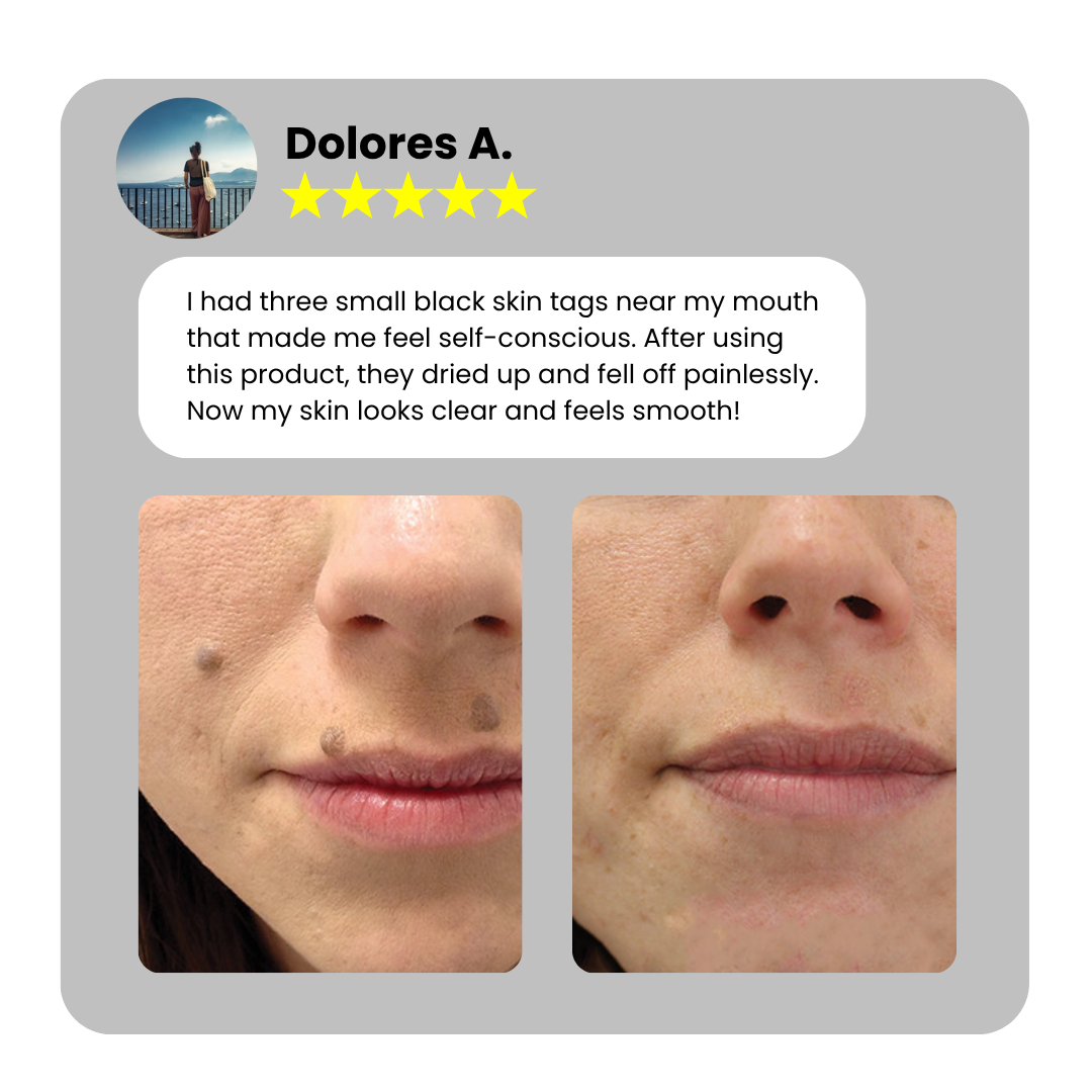 Home Use CO2 Laser Shot Erase Pro