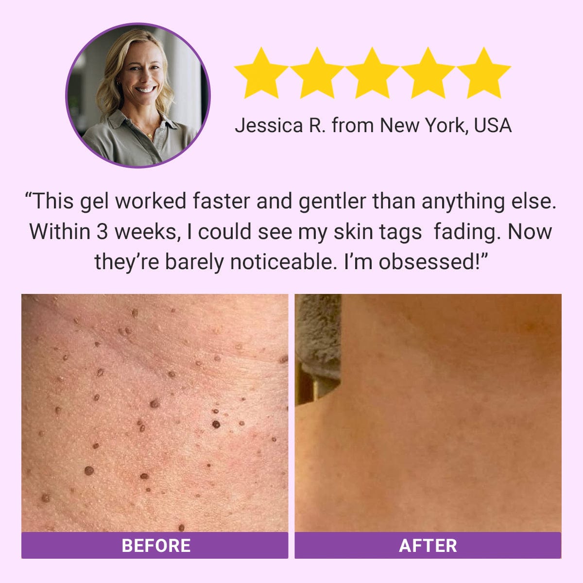 DermaClear Mole and Dark Spot Removal Bio-Gel