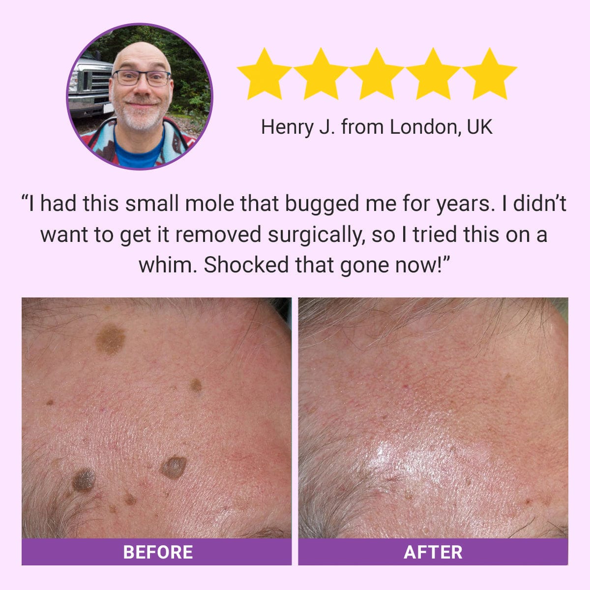 DermaClear Mole and Dark Spot Removal Bio-Gel